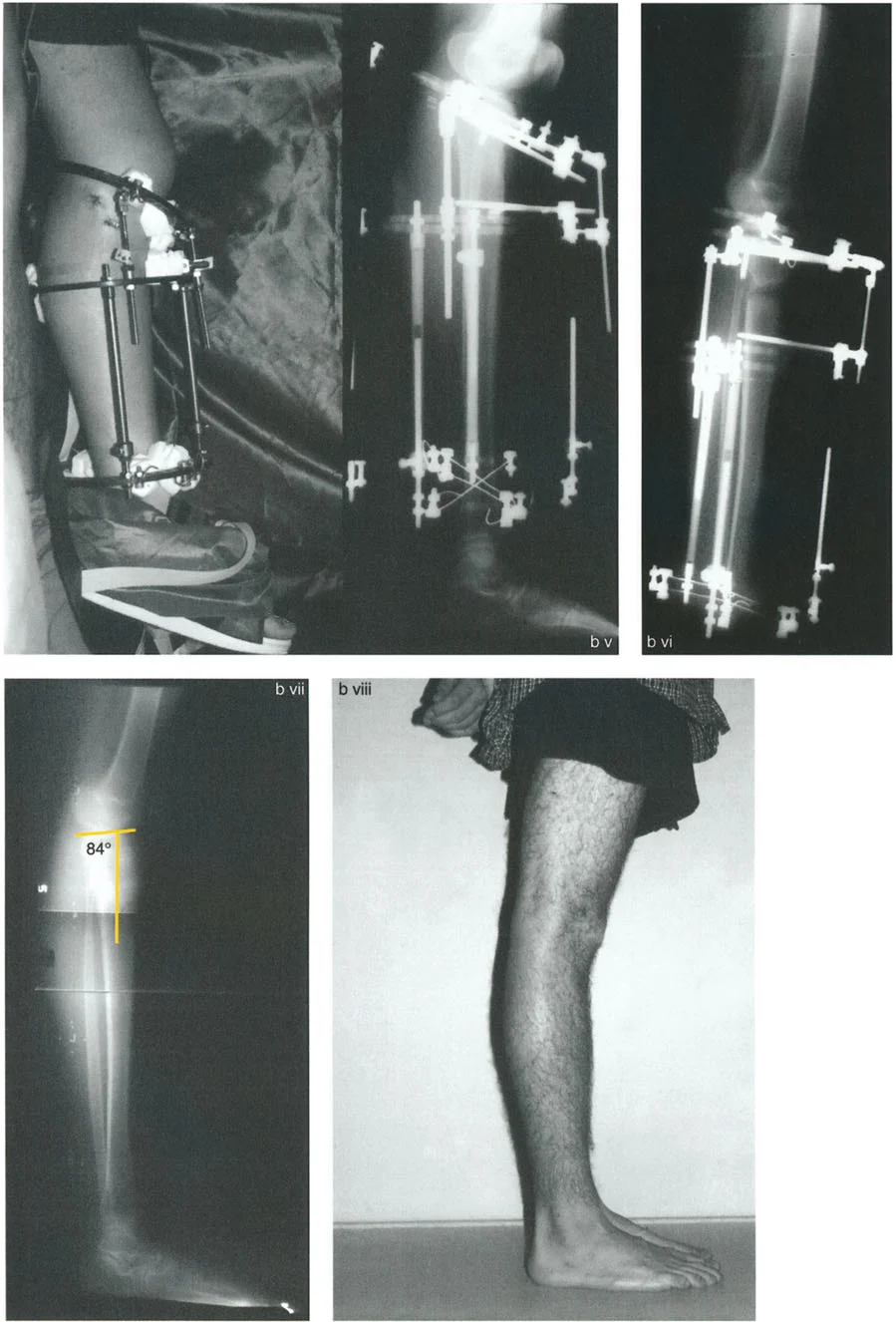 صورة توضيحية لـ الركبة الارتدادية (فرط تمدد الركبة): دليل شامل للعلاج مع الأستاذ الدكتور محمد هطيف