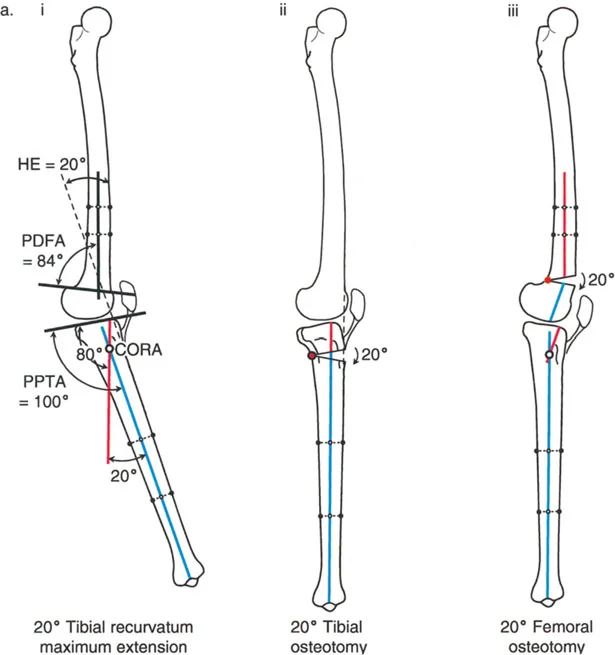 الركبة الارتدادية (فرط تمدد الركبة): دليل شامل للعلاج مع الأستاذ الدكتور محمد هطيف