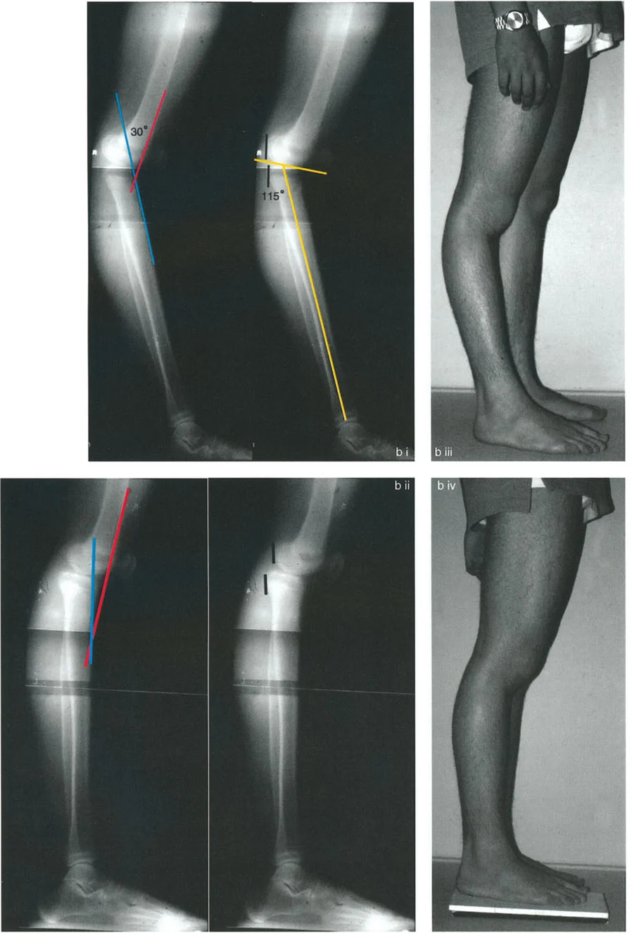 صورة توضيحية لـ الركبة الارتدادية (فرط تمدد الركبة): دليل شامل للعلاج مع الأستاذ الدكتور محمد هطيف