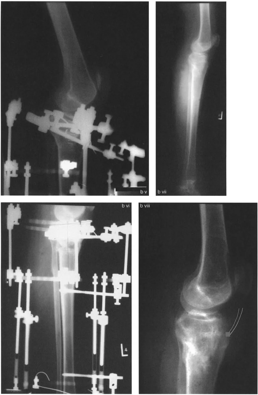 صورة طبية: تشوهات الركبة في المستوى السهمي وعملية جوديه لتقويم العضلة الرباعية: خبرة الأستاذ الدكتور محمد هطيف في صنعاء