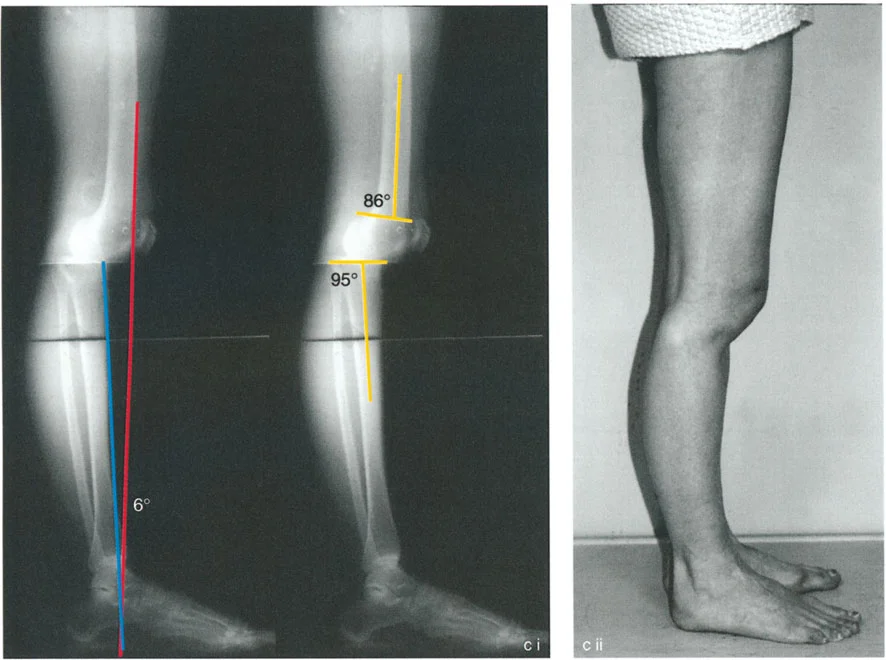 صورة توضيحية لـ تشوهات الركبة في المستوى السهمي وعملية جوديه لتقويم العضلة الرباعية: خبرة الأستاذ الدكتور محمد هطيف في صنعاء
