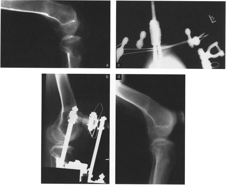 نتائج جراحة قطع العظم على شكل حرف L لاستعادة محاذاة الركبة