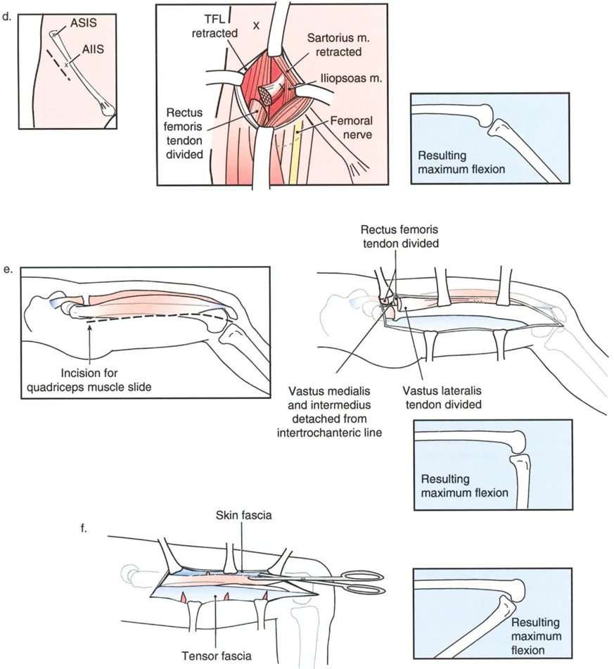 صورة طبية: تشوهات الركبة في المستوى السهمي وعملية جوديه لتقويم العضلة الرباعية: خبرة الأستاذ الدكتور محمد هطيف في صنعاء