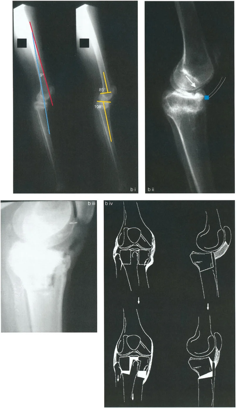 صورة توضيحية للمحاور التشريحية الطبيعية للركبة في المستوى السهمي