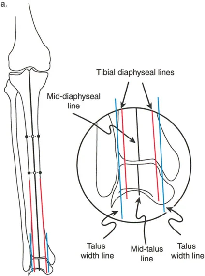تشوهات الركبة في المستوى السهمي وعملية جوديه لتقويم العضلة الرباعية: خبرة الأستاذ الدكتور محمد هطيف في صنعاء