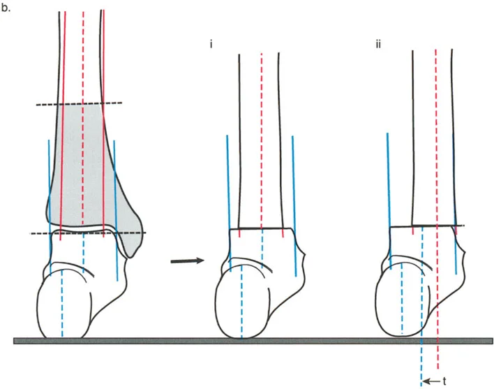 صورة طبية: تشوهات الركبة في المستوى السهمي وعملية جوديه لتقويم العضلة الرباعية: خبرة الأستاذ الدكتور محمد هطيف في صنعاء