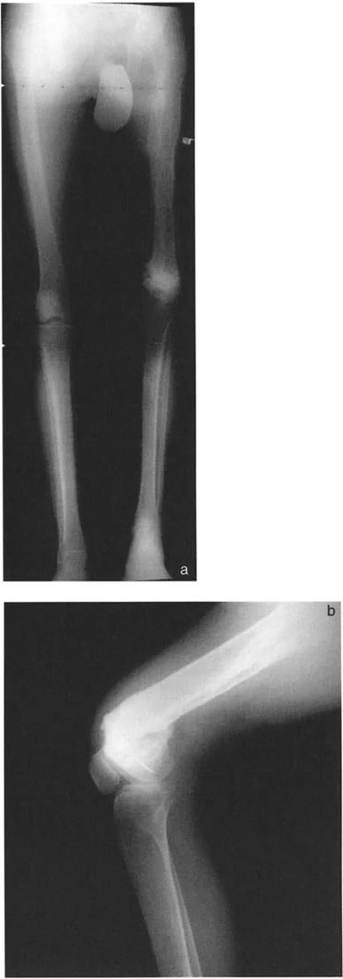 صورة توضيحية لقطع العظم تحت الحدبة الظنبوبية وتأثيره السلبي