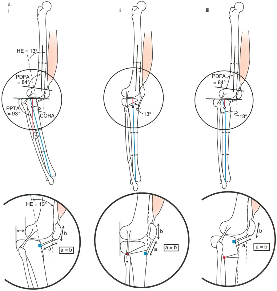تقنية قطع العظم على شكل حرف L لتصحيح التقوس الخلفي بعد الكسور