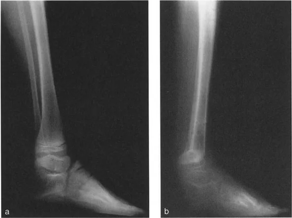 صورة طبية: الاستاذ الدكتور محمد هطيف: دليل شامل لتشوهات قصبة الساق البعيدة والكاحل في صنعاء