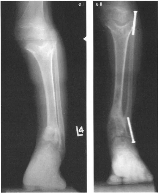صورة طبية: الاستاذ الدكتور محمد هطيف: دليل شامل لتشوهات قصبة الساق البعيدة والكاحل في صنعاء