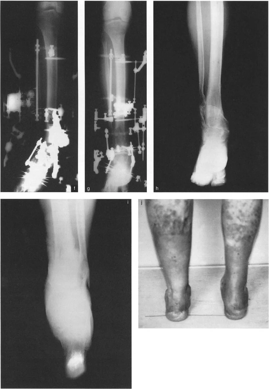 صورة طبية: الاستاذ الدكتور محمد هطيف: دليل شامل لتشوهات قصبة الساق البعيدة والكاحل في صنعاء