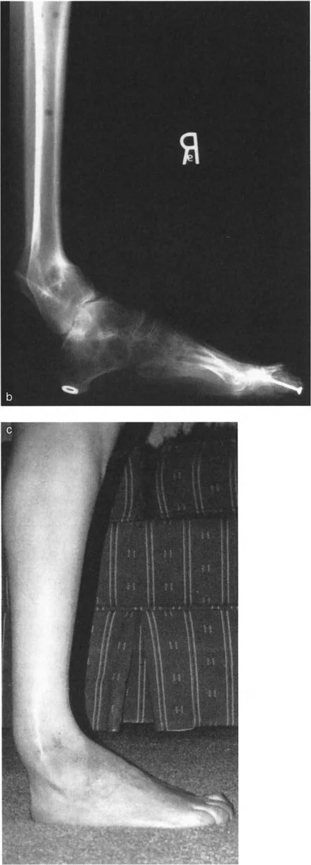 صورة طبية: الاستاذ الدكتور محمد هطيف: دليل شامل لتشوهات قصبة الساق البعيدة والكاحل في صنعاء