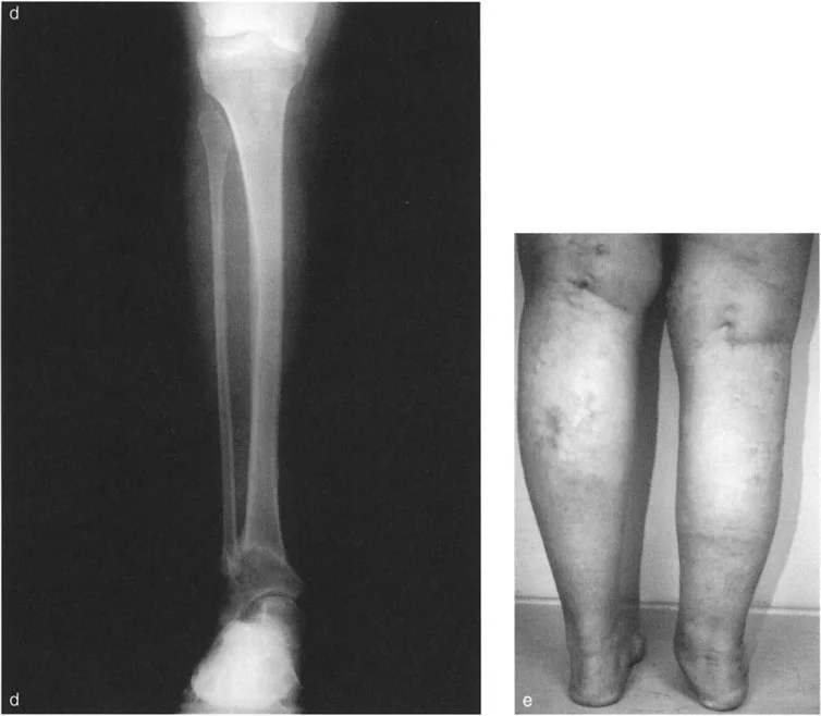 صورة طبية: الاستاذ الدكتور محمد هطيف: دليل شامل لتشوهات قصبة الساق البعيدة والكاحل في صنعاء