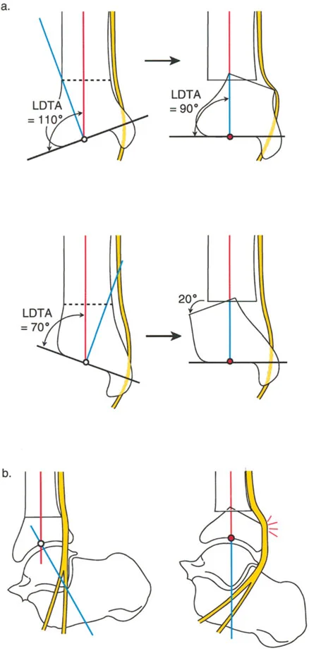 صورة طبية: الاستاذ الدكتور محمد هطيف: دليل شامل لتشوهات قصبة الساق البعيدة والكاحل في صنعاء