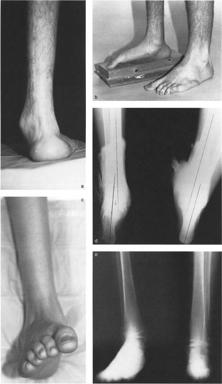 صورة طبية: الاستاذ الدكتور محمد هطيف: دليل شامل لتشوهات قصبة الساق البعيدة والكاحل في صنعاء