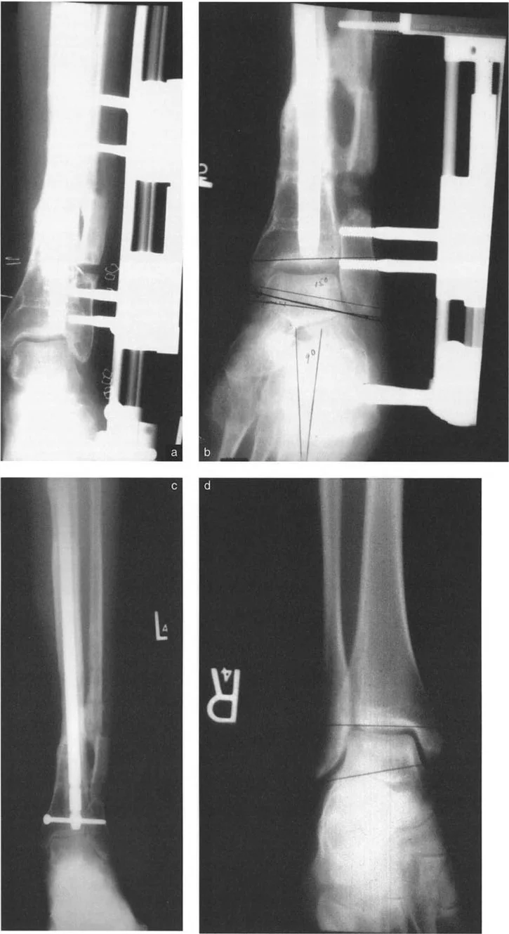 صورة طبية: الاستاذ الدكتور محمد هطيف: دليل شامل لتشوهات قصبة الساق البعيدة والكاحل في صنعاء