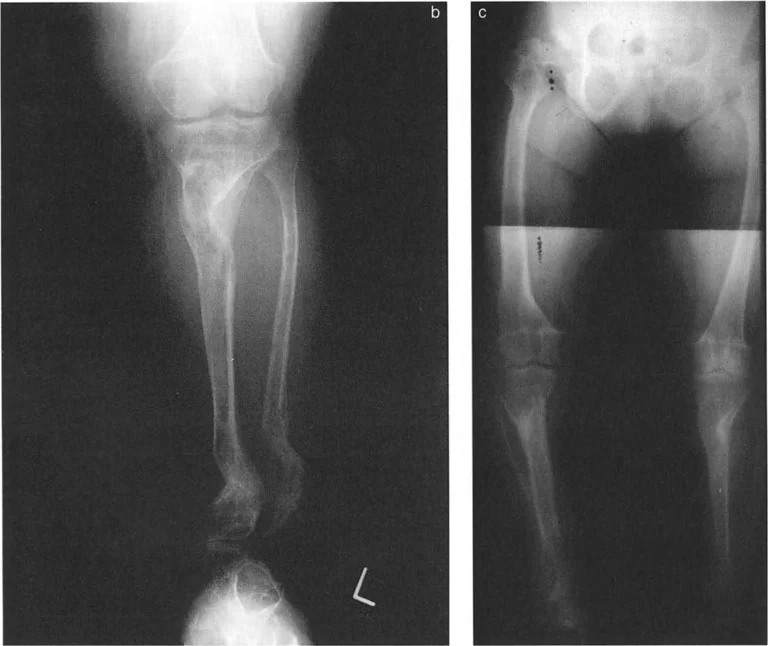 صورة طبية: الاستاذ الدكتور محمد هطيف: دليل شامل لتشوهات قصبة الساق البعيدة والكاحل في صنعاء