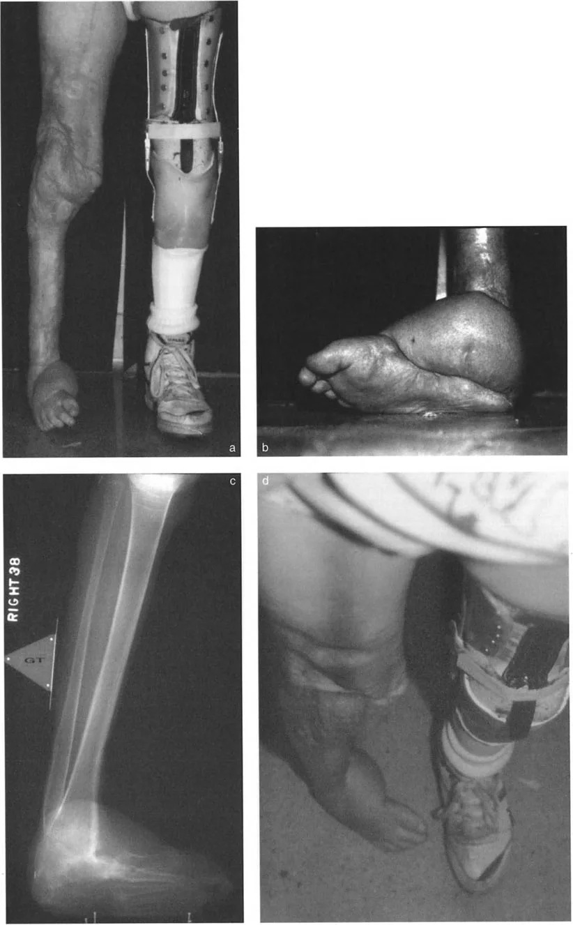 صورة طبية: الاستاذ الدكتور محمد هطيف: دليل شامل لتشوهات قصبة الساق البعيدة والكاحل في صنعاء