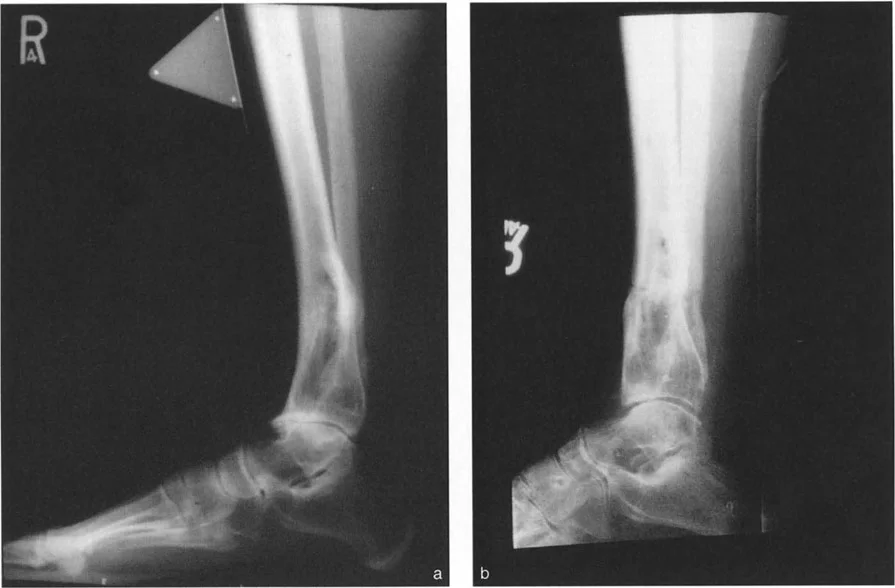 صورة طبية: الاستاذ الدكتور محمد هطيف: دليل شامل لتشوهات قصبة الساق البعيدة والكاحل في صنعاء