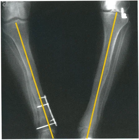 صورة طبية: الاستاذ الدكتور محمد هطيف: دليل شامل لتشوهات قصبة الساق البعيدة والكاحل في صنعاء