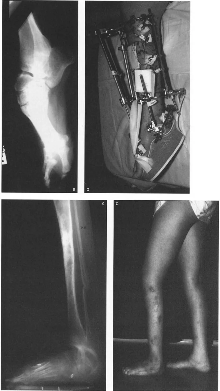 صورة طبية: الاستاذ الدكتور محمد هطيف: دليل شامل لتشوهات قصبة الساق البعيدة والكاحل في صنعاء