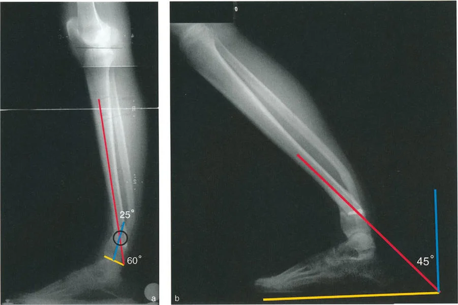 صورة طبية: الاستاذ الدكتور محمد هطيف: دليل شامل لتشوهات قصبة الساق البعيدة والكاحل في صنعاء