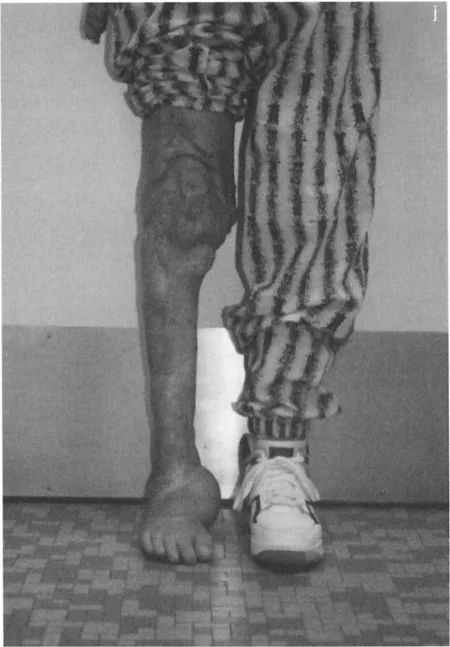 صورة طبية: الاستاذ الدكتور محمد هطيف: دليل شامل لتشوهات قصبة الساق البعيدة والكاحل في صنعاء