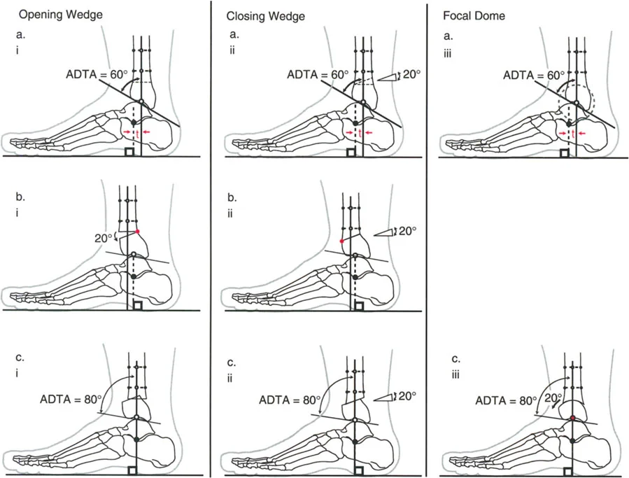 صورة طبية: الاستاذ الدكتور محمد هطيف: دليل شامل لتشوهات قصبة الساق البعيدة والكاحل في صنعاء