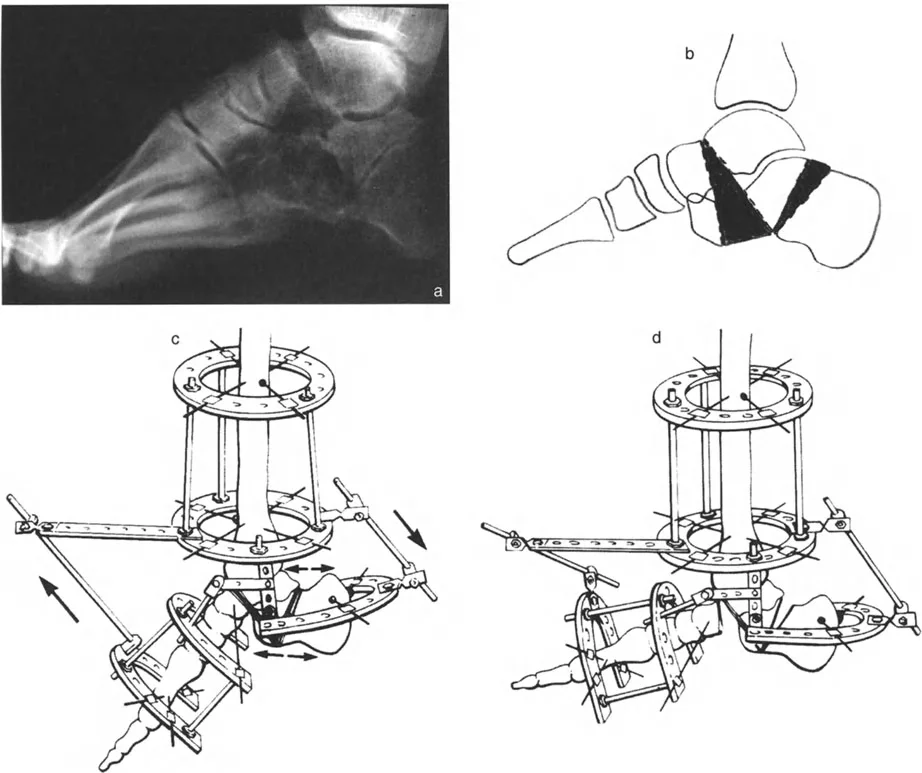 صورة طبية: الاستاذ الدكتور محمد هطيف: دليل شامل لتشوهات قصبة الساق البعيدة والكاحل في صنعاء