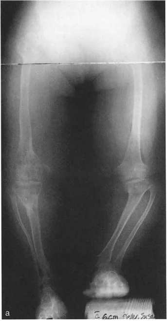 صورة طبية: الاستاذ الدكتور محمد هطيف: دليل شامل لتشوهات قصبة الساق البعيدة والكاحل في صنعاء