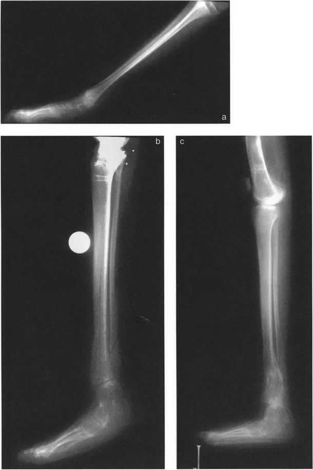 صورة طبية: الاستاذ الدكتور محمد هطيف: دليل شامل لتشوهات قصبة الساق البعيدة والكاحل في صنعاء