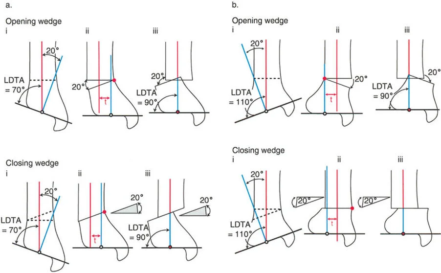 صورة طبية: الاستاذ الدكتور محمد هطيف: دليل شامل لتشوهات قصبة الساق البعيدة والكاحل في صنعاء