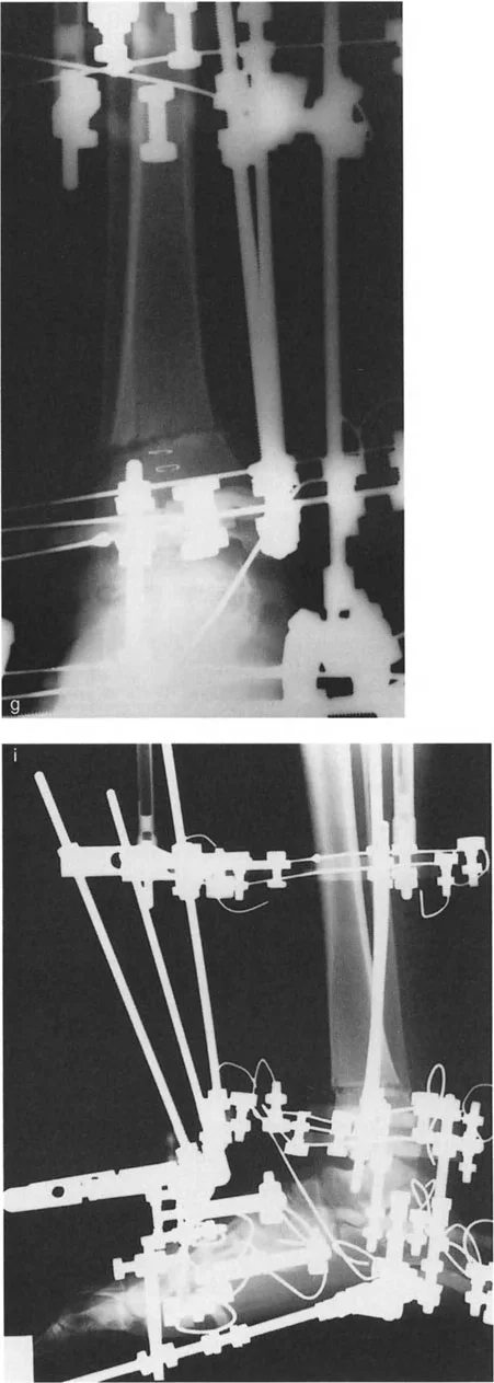 صورة طبية: الاستاذ الدكتور محمد هطيف: دليل شامل لتشوهات قصبة الساق البعيدة والكاحل في صنعاء