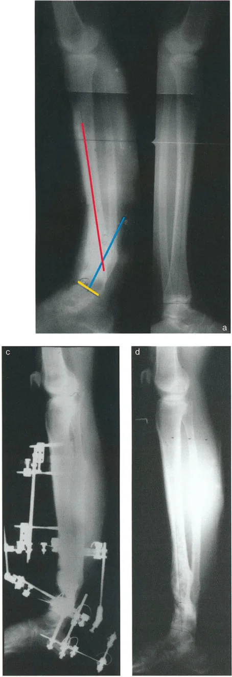 صورة طبية: الاستاذ الدكتور محمد هطيف: دليل شامل لتشوهات قصبة الساق البعيدة والكاحل في صنعاء