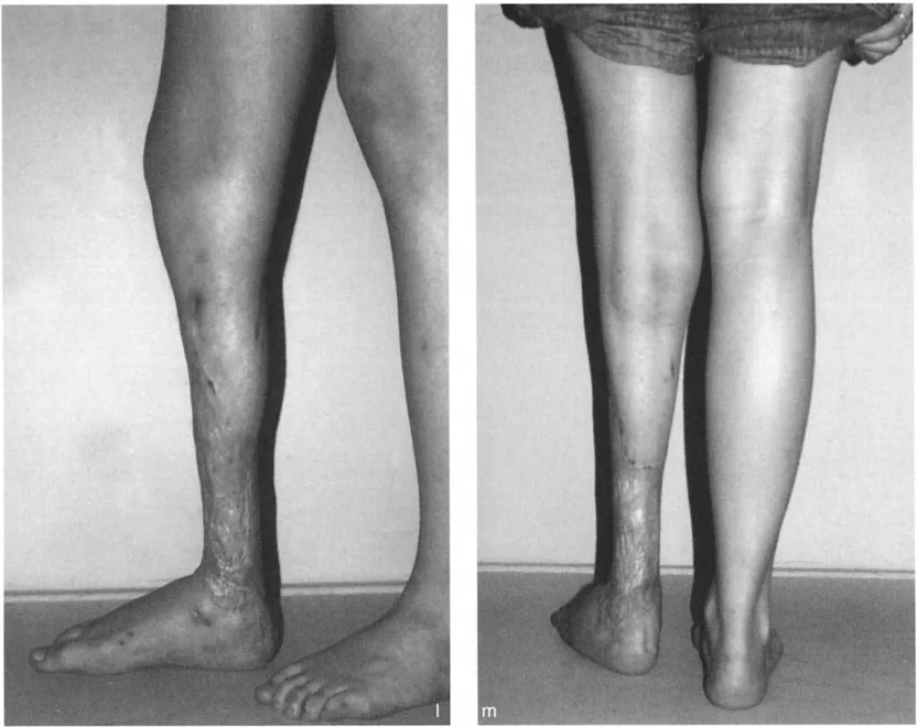 صورة طبية: تشوهات الكاحل والقدم: الأسباب، التشخيص، والعلاج المتقدم مع الأستاذ الدكتور محمد هطيف في صنعاء