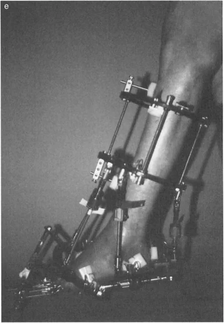 صورة طبية: تشوهات الكاحل والقدم: الأسباب، التشخيص، والعلاج المتقدم مع الأستاذ الدكتور محمد هطيف في صنعاء