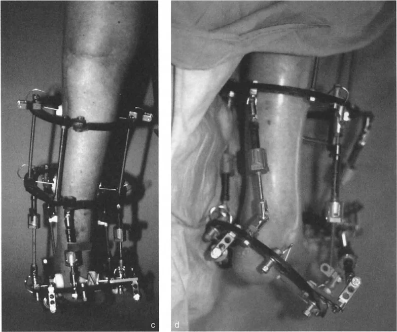 صورة طبية: تشوهات الكاحل والقدم: الأسباب، التشخيص، والعلاج المتقدم مع الأستاذ الدكتور محمد هطيف في صنعاء