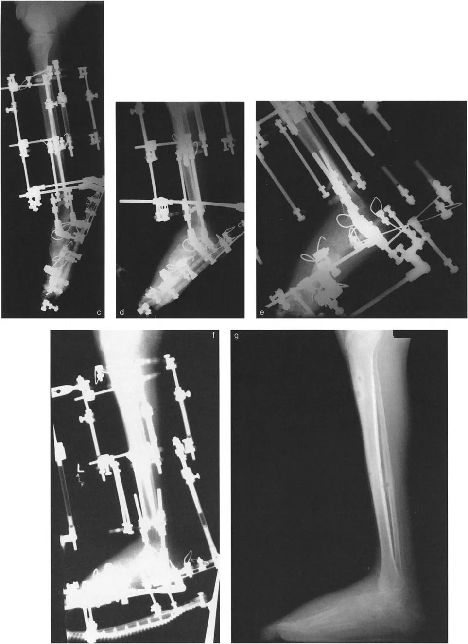 صورة توضيحية لـ تشوهات الكاحل والقدم: الأسباب، التشخيص، والعلاج المتقدم مع الأستاذ الدكتور محمد هطيف في صنعاء