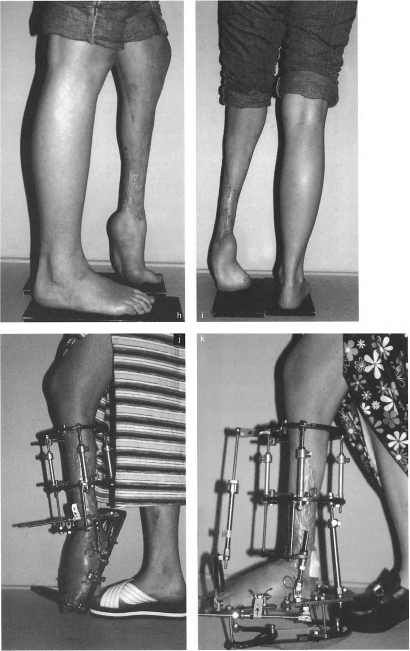 صورة توضيحية لـ تشوهات الكاحل والقدم: الأسباب، التشخيص، والعلاج المتقدم مع الأستاذ الدكتور محمد هطيف في صنعاء