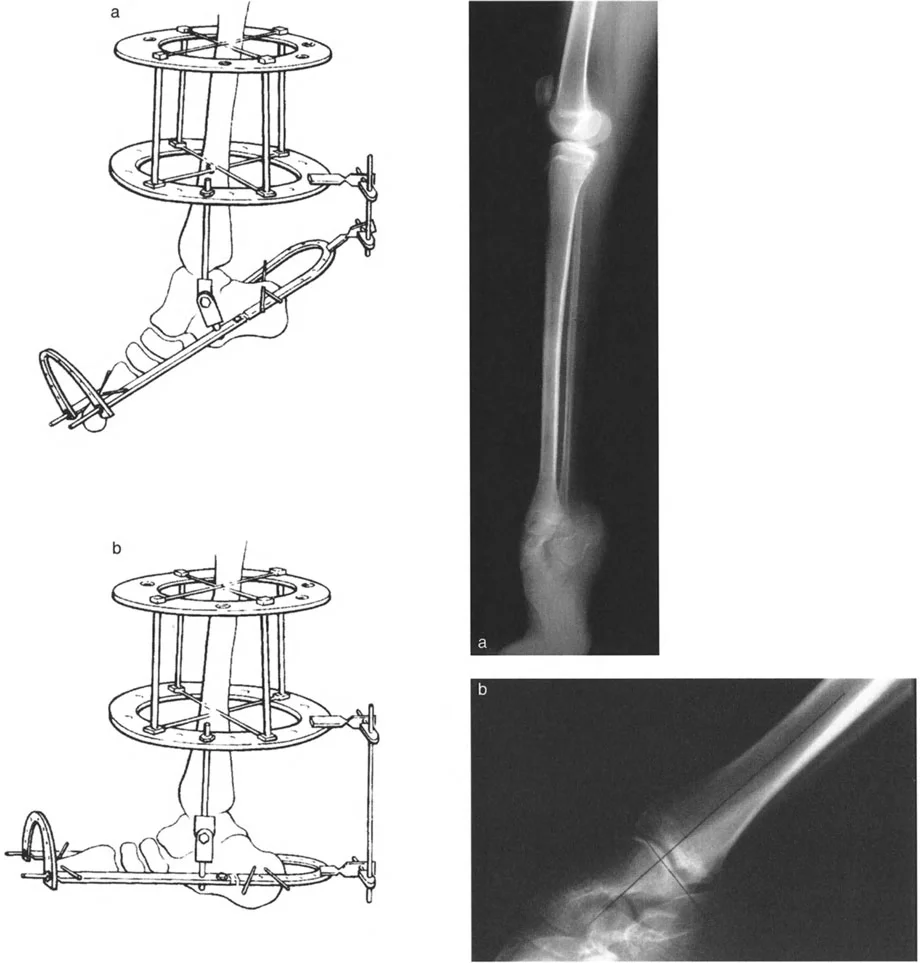 صورة توضيحية لـ تشوهات الكاحل والقدم: الأسباب، التشخيص، والعلاج المتقدم مع الأستاذ الدكتور محمد هطيف في صنعاء