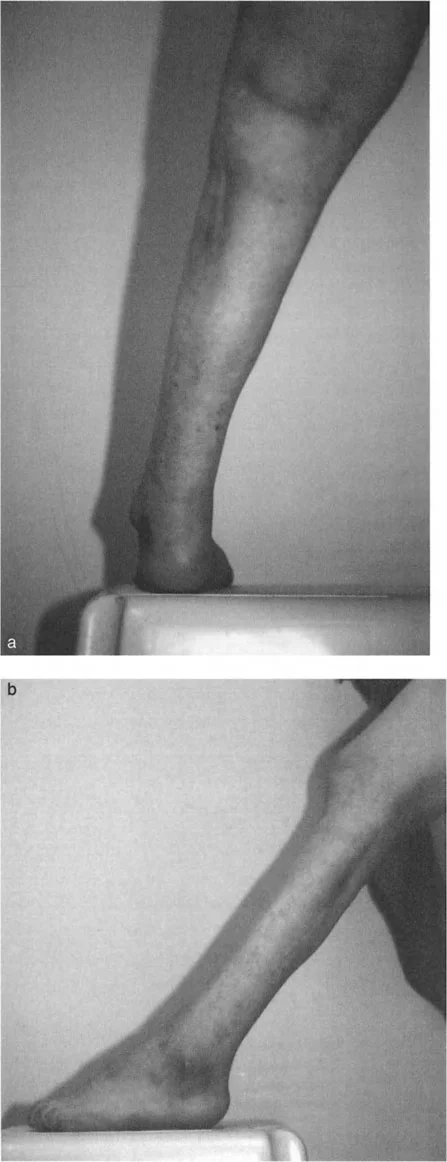 صورة طبية: تشوهات الكاحل والقدم: الأسباب، التشخيص، والعلاج المتقدم مع الأستاذ الدكتور محمد هطيف في صنعاء
