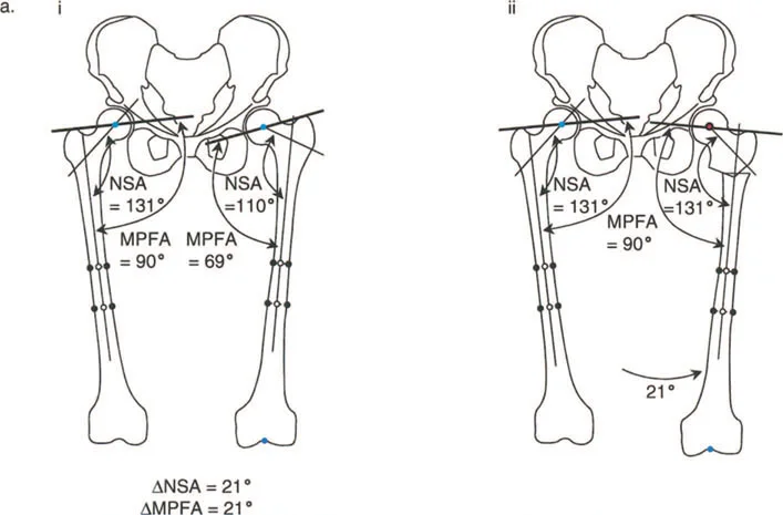 صورة طبية: جراحة عظم الفخذ التقويمية للورك: حلول متقدمة لتشوهات الورك مع الأستاذ الدكتور محمد هطيف