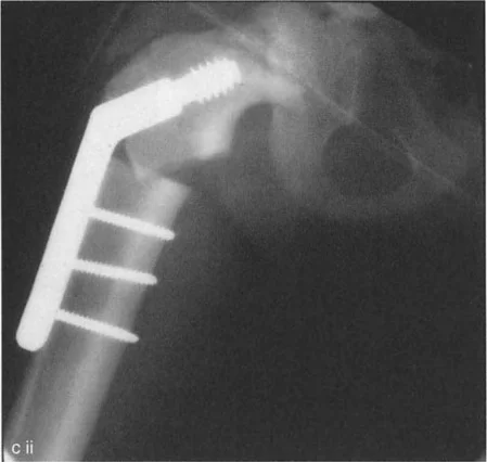 صورة طبية: جراحة عظم الفخذ التقويمية للورك: حلول متقدمة لتشوهات الورك مع الأستاذ الدكتور محمد هطيف