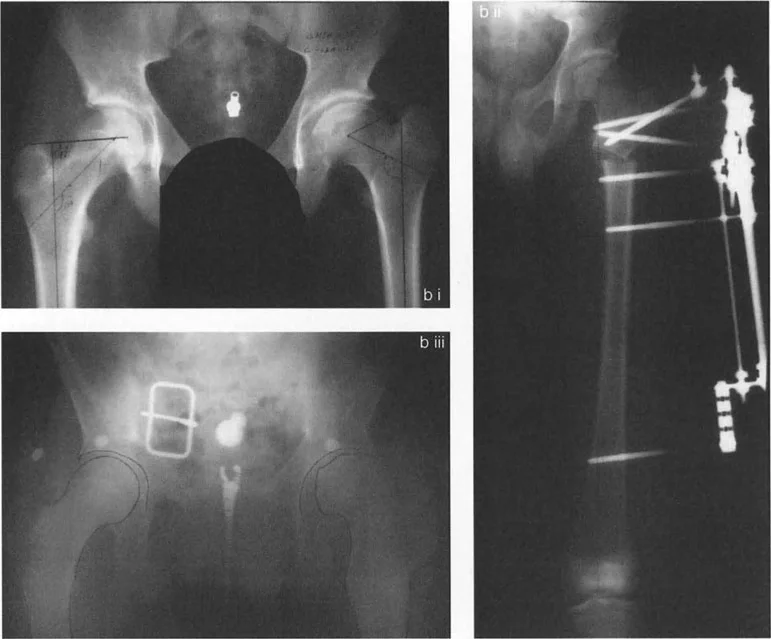 صورة طبية: جراحة عظم الفخذ التقويمية للورك: حلول متقدمة لتشوهات الورك مع الأستاذ الدكتور محمد هطيف