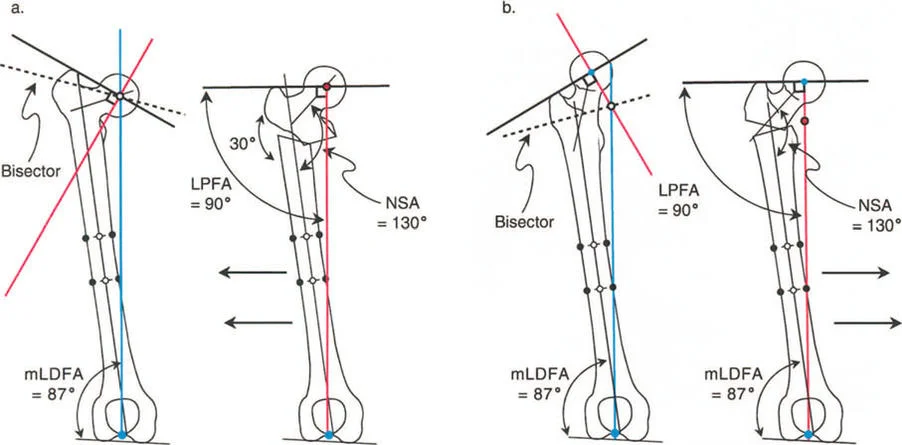 صورة طبية: جراحة عظم الفخذ التقويمية للورك: حلول متقدمة لتشوهات الورك مع الأستاذ الدكتور محمد هطيف
