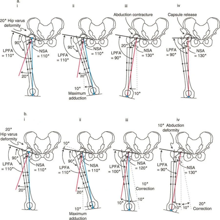 صورة طبية: جراحة عظم الفخذ التقويمية للورك: حلول متقدمة لتشوهات الورك مع الأستاذ الدكتور محمد هطيف
