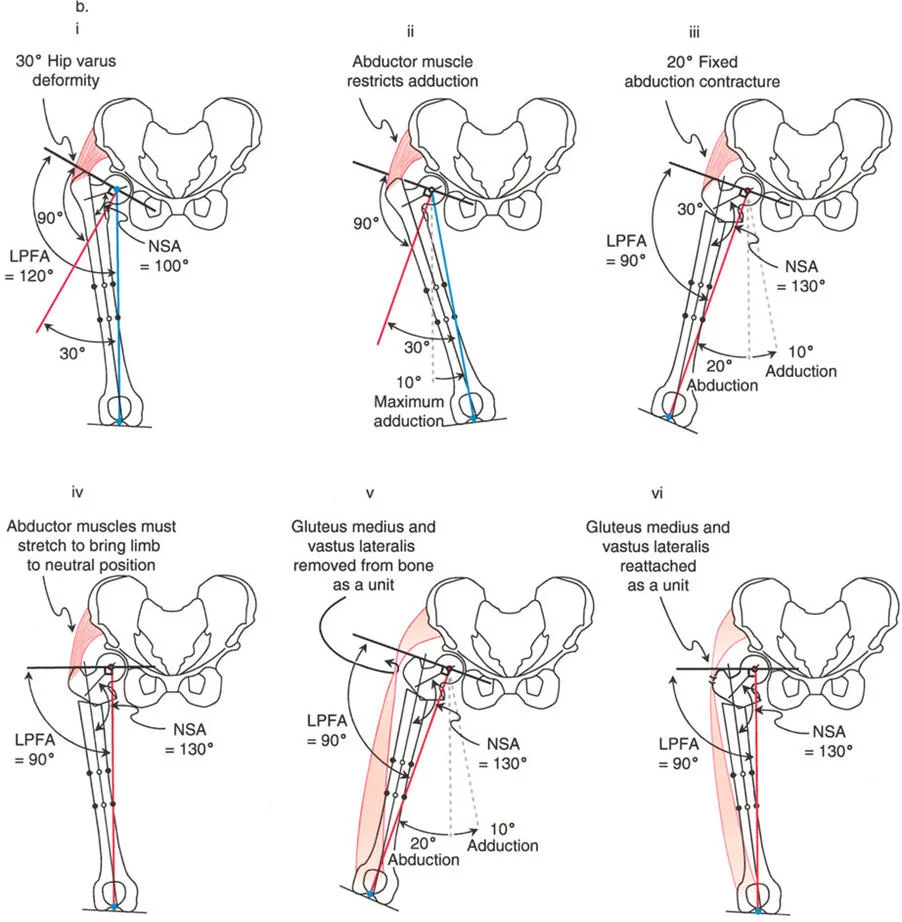 صورة توضيحية لـ جراحة عظم الفخذ التقويمية للورك: حلول متقدمة لتشوهات الورك مع الأستاذ الدكتور محمد هطيف