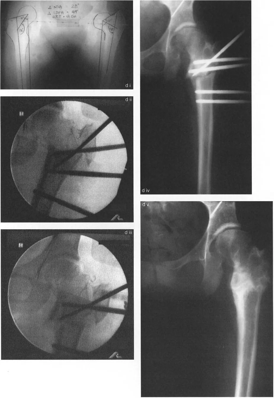 جراحات تقويم تشوهات مفصل الورك: الحل الشامل لاستعادة الحركة وتخفيف الألم