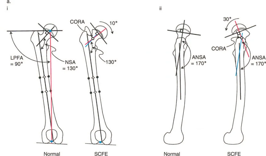 صورة طبية: دليلك الشامل لتصحيح تشوهات مفصل الورك: من التشخيص إلى التعافي مع الأستاذ الدكتور محمد هطيف في صنعاء