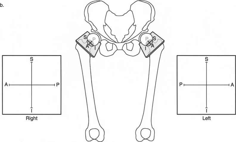 صورة طبية: دليلك الشامل لتصحيح تشوهات مفصل الورك: من التشخيص إلى التعافي مع الأستاذ الدكتور محمد هطيف في صنعاء
